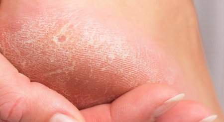 appareil-pour-corne-des-pieds